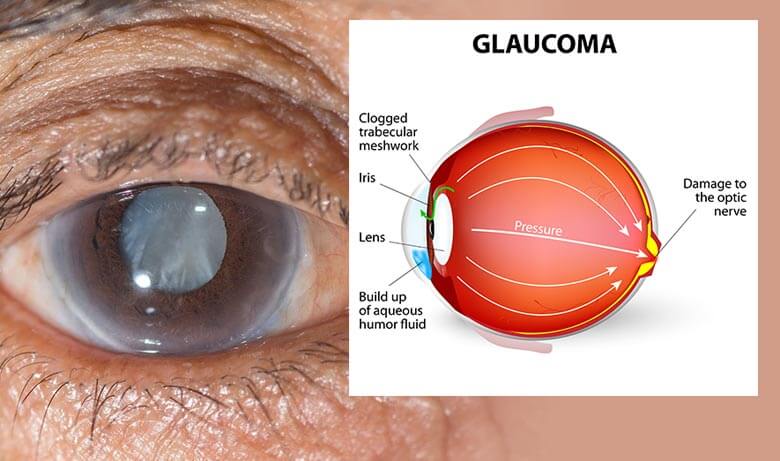 Ejemplo de un ojo con glaucoma.
