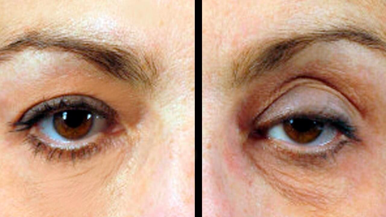 Comparativo de un ojo normal y un ojo con blefaroplastia.