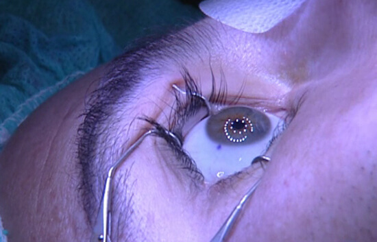 Ojo abierto en una cirugía oftalmólogica.