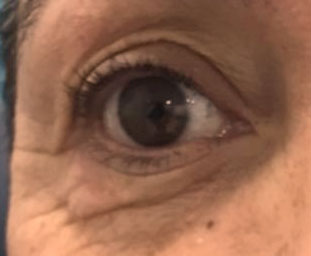 Imagen de un ojo antes de una cirujía de visión.