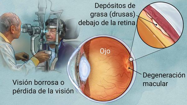Ilustración donde se ve a un oftalmólogo revisando a su paciente, donde se alcana a percibir una degeneración macular del ojo.