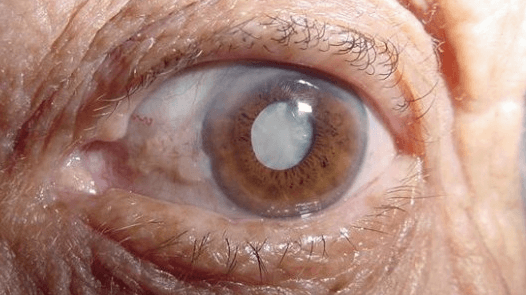 Ojo de adulto mayor con catarata.