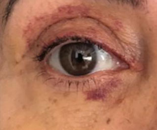 Imagen de un ojo sano después de una cirujía de visión.